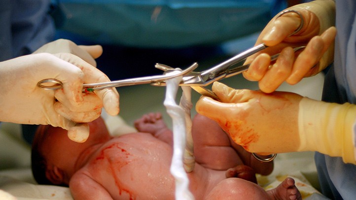 Early Cord Clamping – Another Planned Medical Attach on Infants