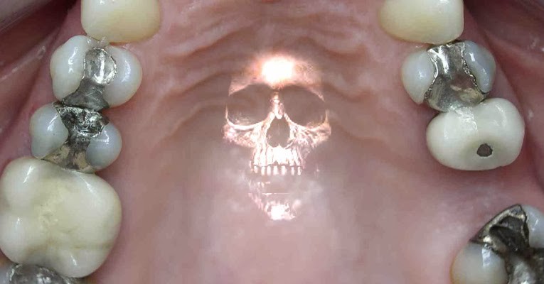 Dental Bullying and The Mercury Filling/Flourish Lie