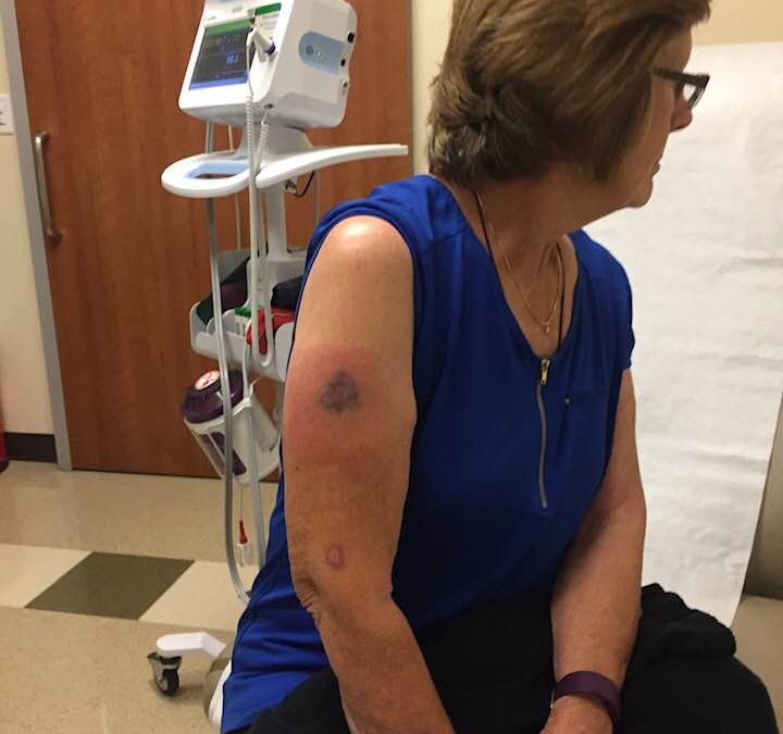 Flu Shot Destroys Woman’s Arm………..