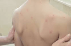 Cases of Chickenpox in Those Fully Vaccinated Against it
