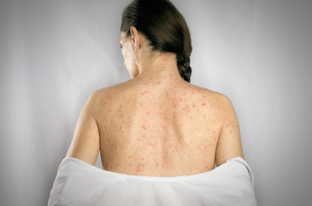 When Vaccines Fail….The Media and Governments Just Lie Harder